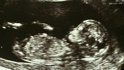 ULTRASOUND FETUS STOCK