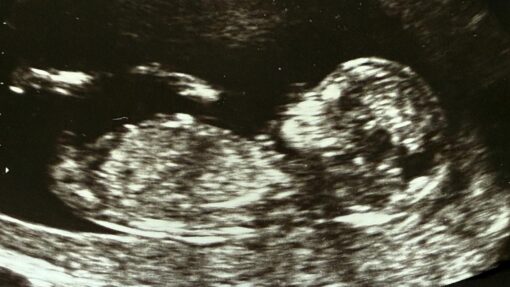 ULTRASOUND FETUS STOCK