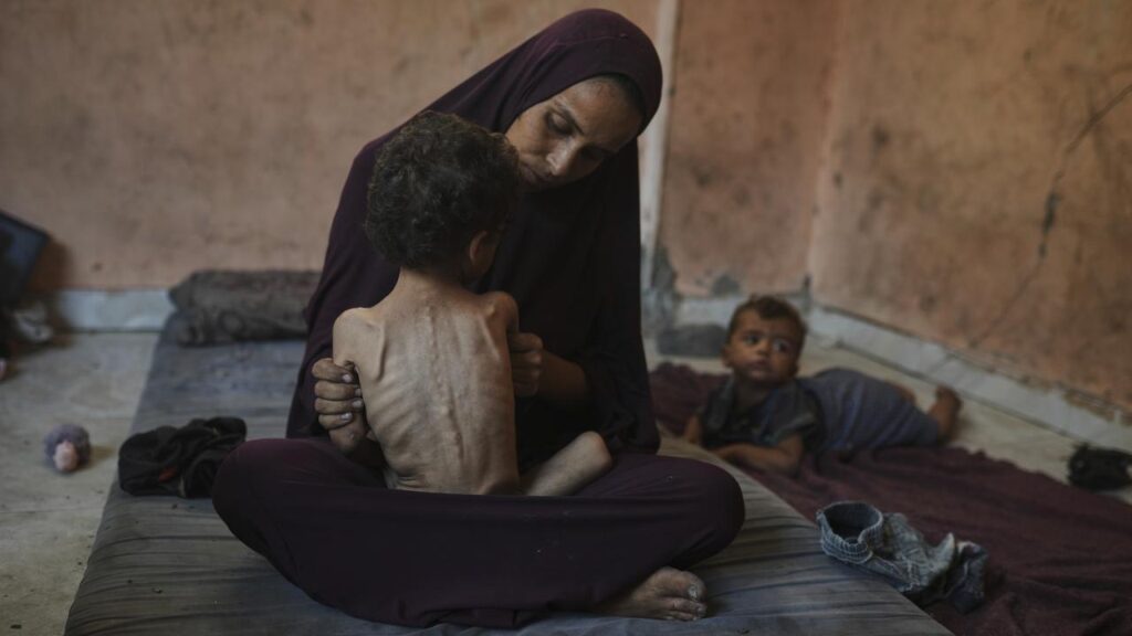 Two year old malnourished child, Yazan, is among Gazan children at risk of death from starvation.
