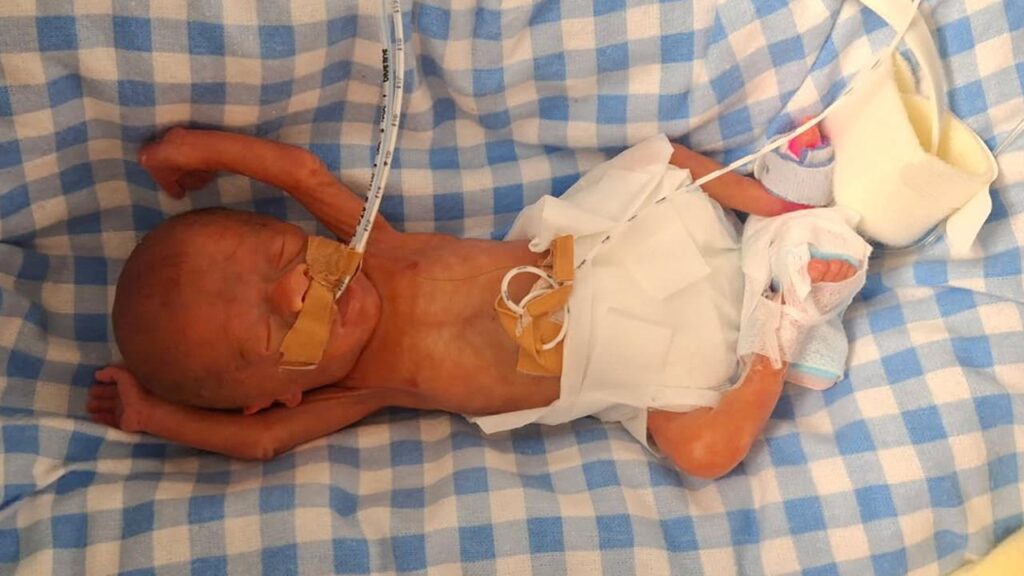 Tiny newborn Charlie Jones has made history as one of the nation’s smallest premmie babies. 
