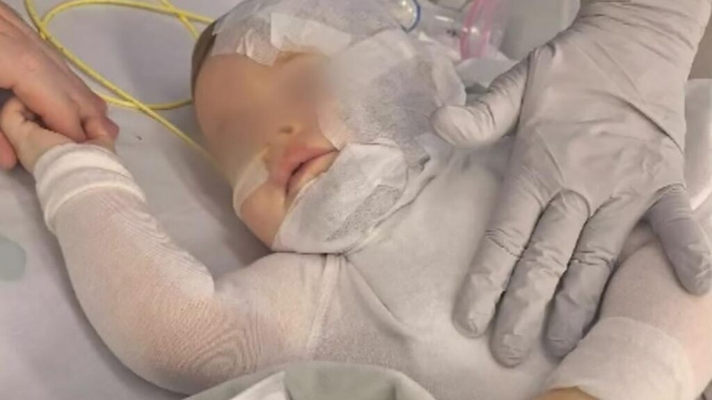 Baby Luka suffered horrific burns to his chest, neck and face and endured eight surgeries.
