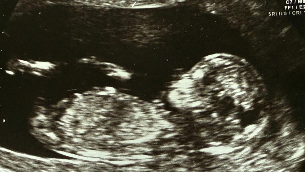 Shares in Monash IVF bounced by almost 16 per cent to 77 cents after a takeover offer was revealed.
