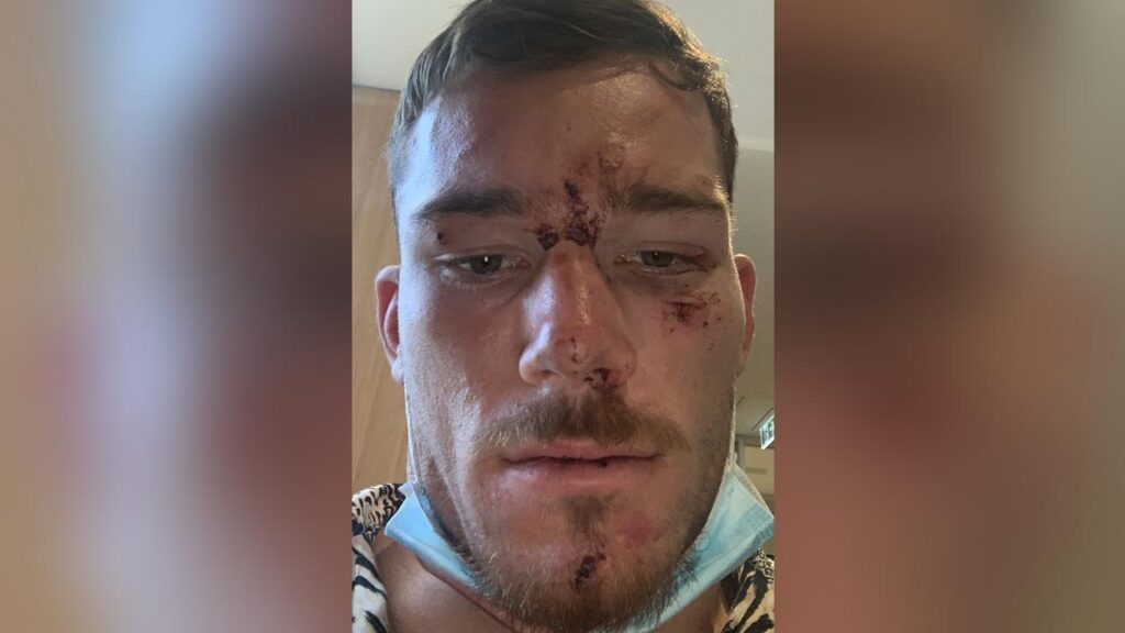 Tom Starling suffered concussion and a bloodied face when allegedly assaulted by police at a bar.
