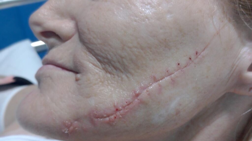 A scar down the entire side of Emma Larnach’s face is a permanent reminder of the frenzied attack.
